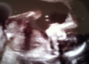 My son, Miles, at 20 weeks gestation